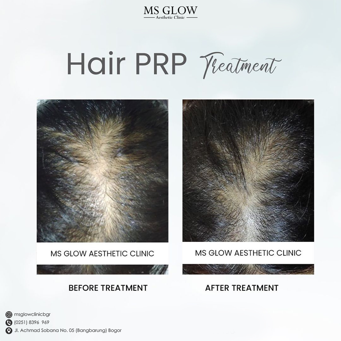 Hair PRP Treatment