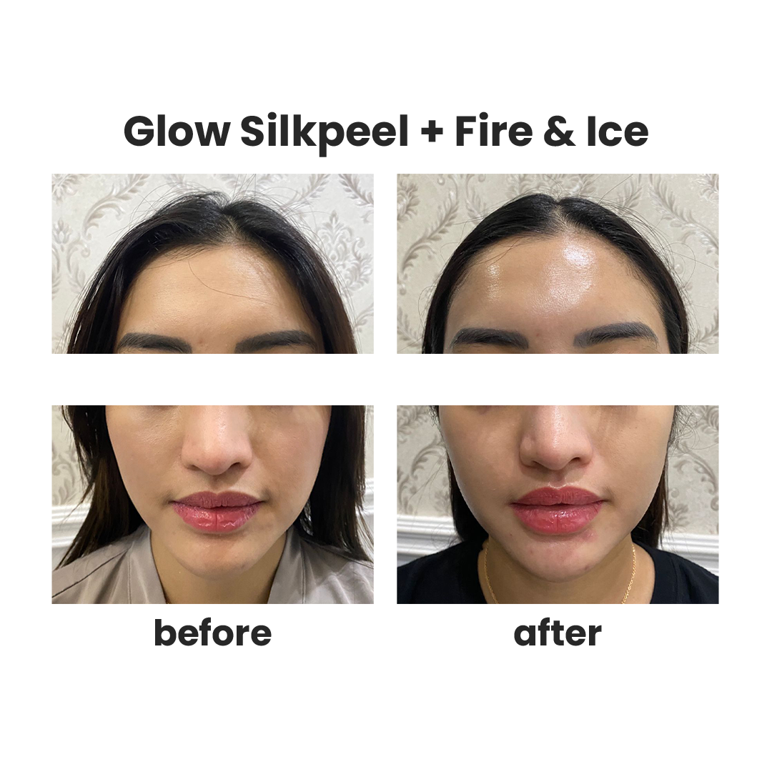 Glow silkpeel + fire & Ice