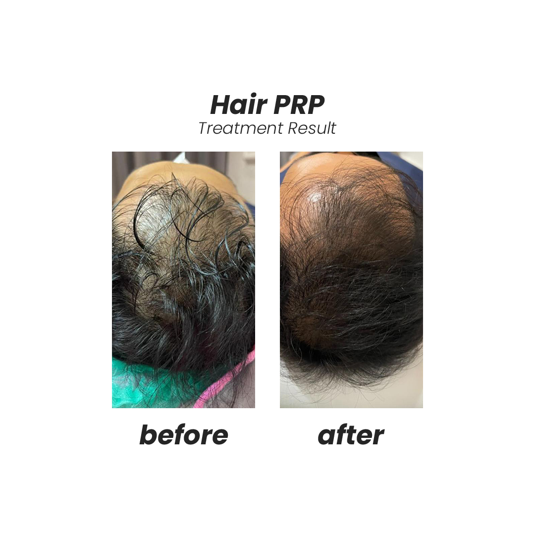 Hair PRP