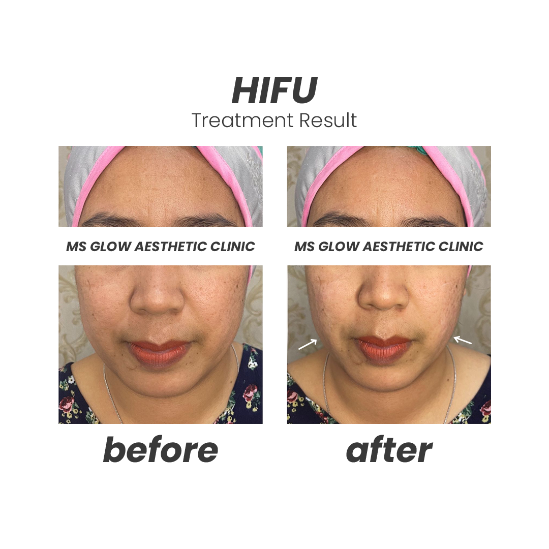 V-Shape HIFU 3