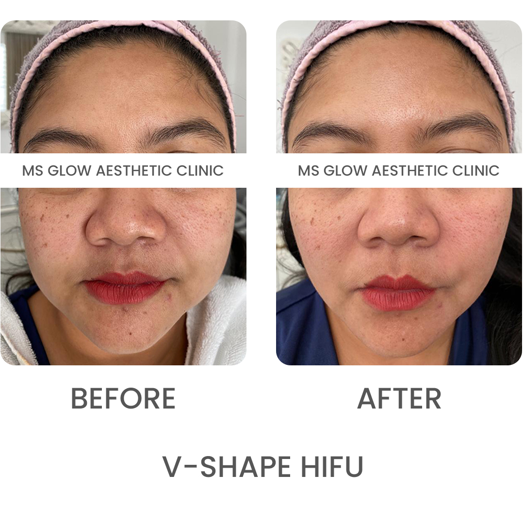 V-shape HIFU