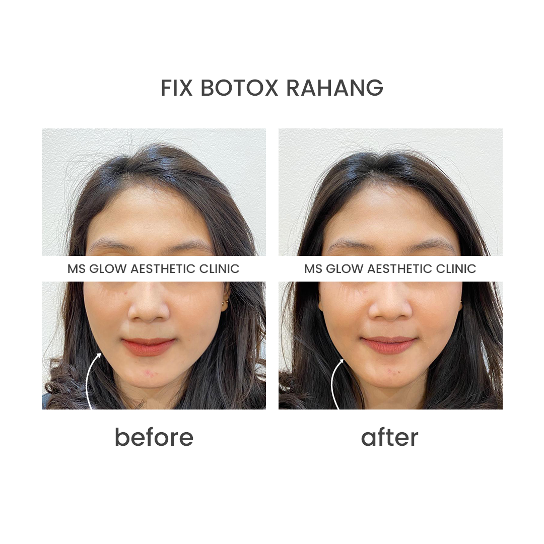 fix botox rahang semarang