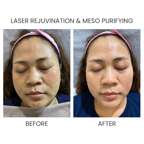 LASER REJUV & MESO PURIFYING