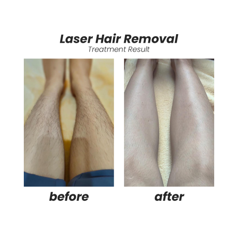Laser Hair Removal